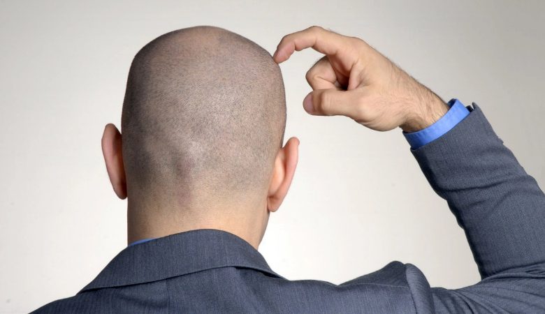 man bald (1)